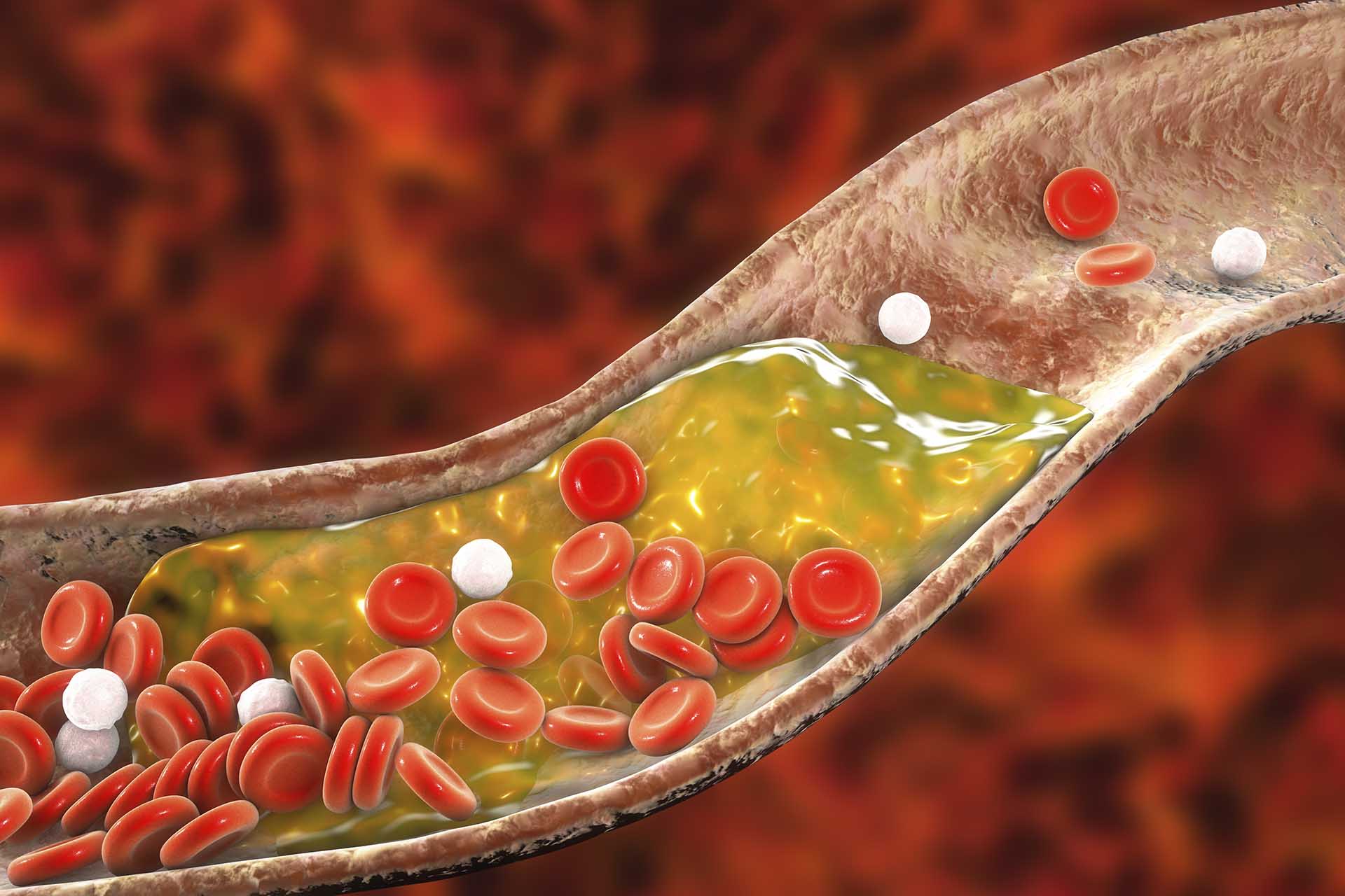 what-is-high-cholesterol-iran-darouk